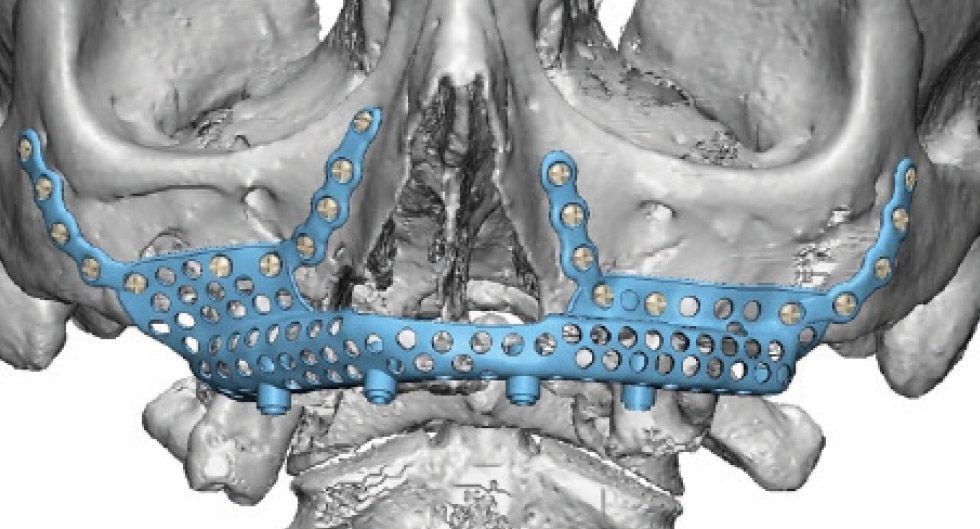 La prótesis de titanio que reconstruye el hueso maxilar superior k2_items_src_87e6e3ab5b5ac79f45a46cd7037647c3