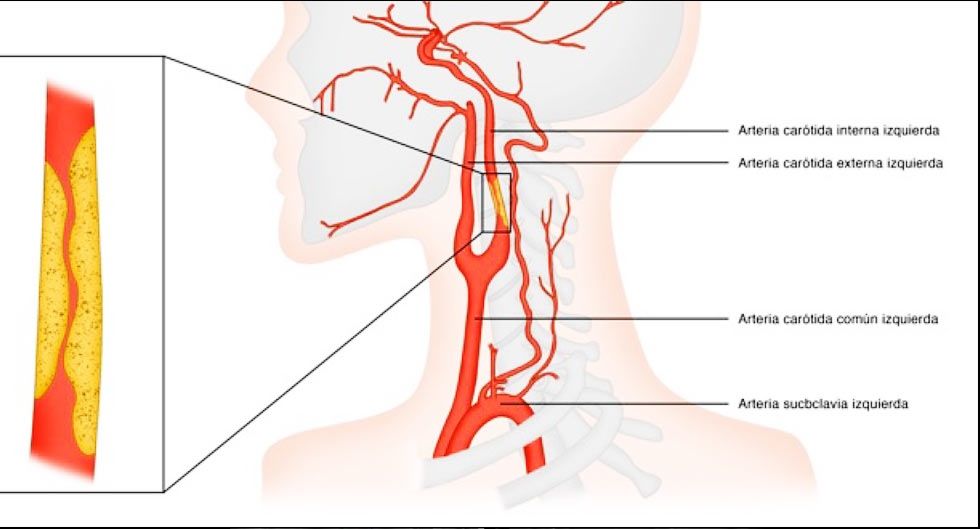 El Hospital Ruber Internacional opera con éxito un caso de estenosis carotídea posterior a radioterapia k2_items_src_d0d5caef53a97465ee5797663b3cd459
