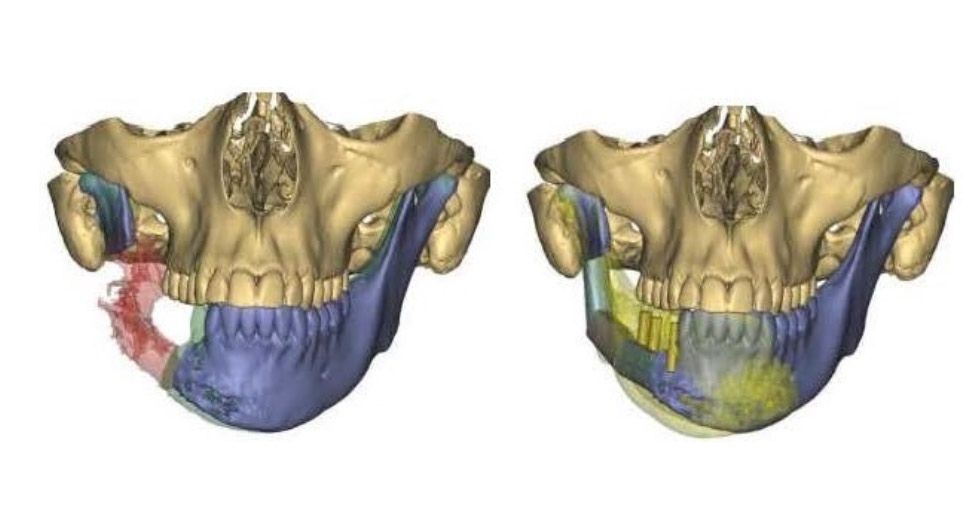 Recuperar la dentición tras un cáncer de cavidad oral k2_items_src_b8c76ee8ebbe7de4df8bd61f72161540