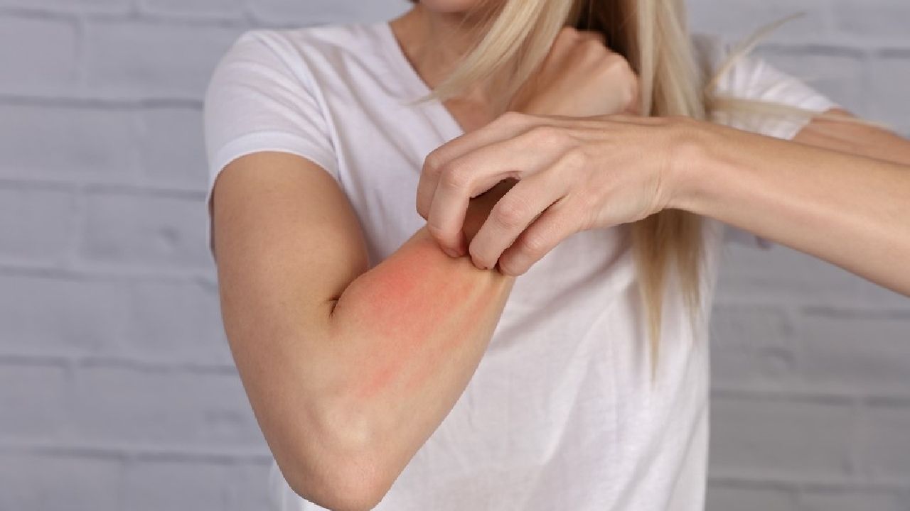 Más de 300.000 personas padecen urticaria crónica en España k2_items_src_3205be320032f6b588d2e58d6e2457b2