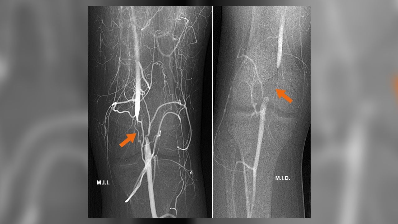 Atrapamiento de la arteria poplítea, una causa infrecuente de claudicación en personas jóvenes k2_items_src_3d50d1c50461be217bd1968e4d330b97