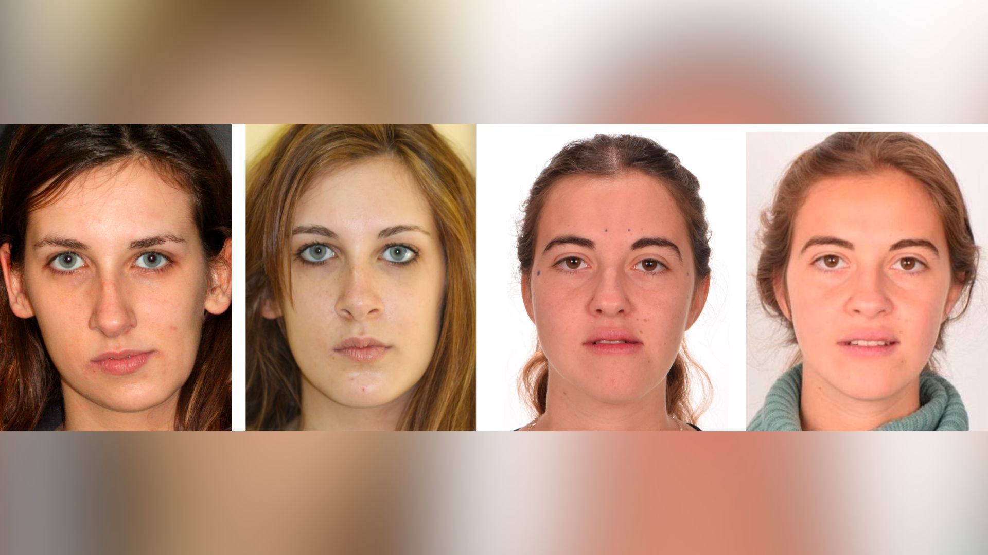 Cirugía ortognática: la solución para la corrección de maloclusiones dentales y asimetrías faciales Cirugia ortognática