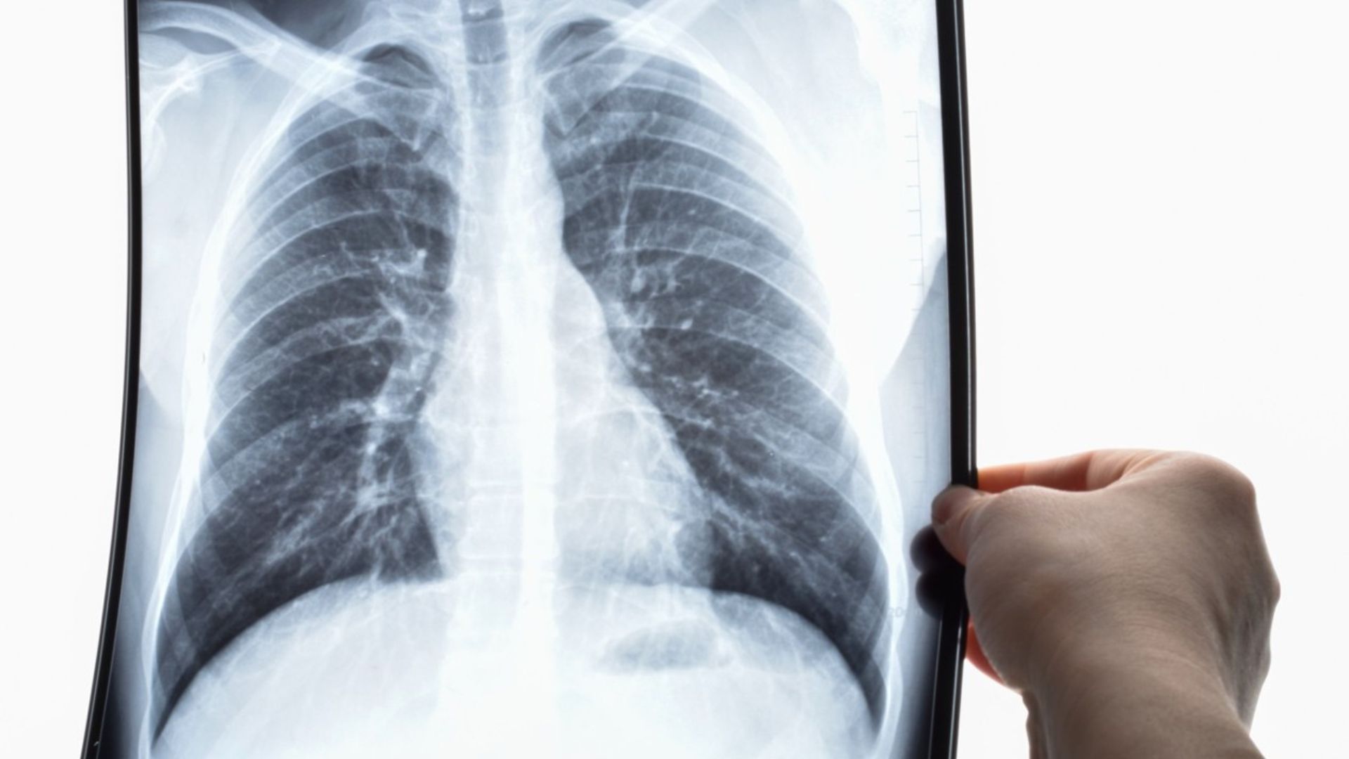 Programa de screening de cáncer de pulmón: una alianza para luchar contra la enfermedad Radiografía de Pulmón